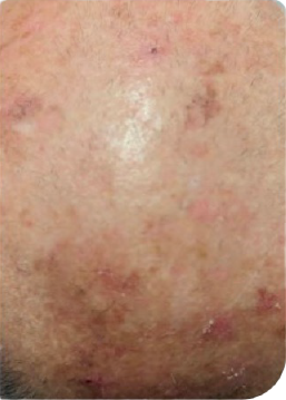 Real World Effectiveness Day 0