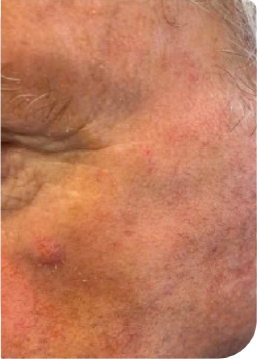 Real World Effectiveness Follow Up