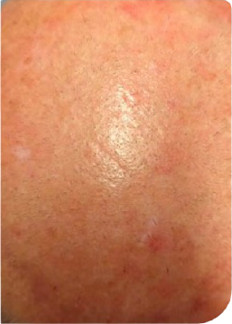 Real World Effectiveness Follow up